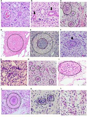 Intralesional Infiltrations of Cell-Free Filtrates Derived from Human Diabetic Tissues Delay the Healing Process and Recreate Diabetes Histopathological Changes in Healthy Rats
